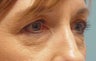 Lower blepharoplasty with fat repositioning