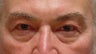 Lower blepharoplasty with fat repositioning