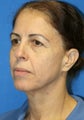 eye rejuvenation