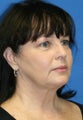eye rejuvenation