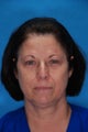 Blepharoplasty