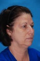 Blepharoplasty