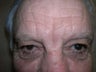 Blepharoplasty