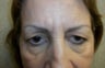 Blepharoplasty