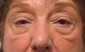 Upper eyelid ptosis repair and lower eyelid blepharoplasty and midface lift