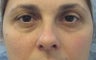 Lower eyelid blepharoplasty with cheek lift 