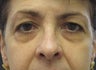 Upper and lower bleph and cheek lift