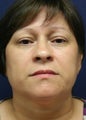 Eyelid Surgery