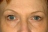 Eyelid Surgery