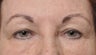 Eyelid Surgery