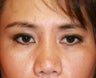 Upper eyelid blepharoplasty