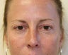 Upper and Lower Eyelids