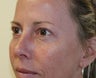 Upper and Lower Eyelids