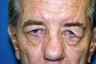 Blepharoplasty