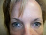 Blepharoplasty