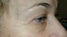 Eyelid Surgery
