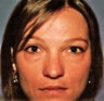 Blepharoplasty (Upper and Lower eyelids)