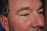 Blepharoplasty (lower eyelid surgery)