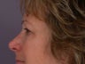 Eyelid Surgery
