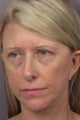 Eyelid Surgery