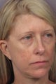Eyelid Surgery