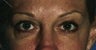 Upper and lower eyelid (blepharoplasty) Surgery