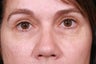 Blepharoplasty / Eyelid Surgery