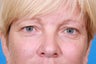 Blepharoplasty / Eyelid Surgery