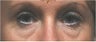 Eyelid Surgery