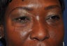 Blepharoplasty (Upper and Lower eyelids)