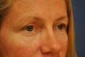 Blepharoplasty (Upper eyelids)
