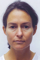 Brow Lift