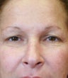 blepharoplasty