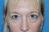 Upper and Lower Eyelid Blepharoplasty