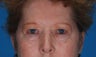blepharoplasty with endoscopic brow lift