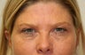 Eyelid Surgery