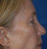 Eyelid Surgery
