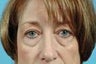Eyelid Surgery