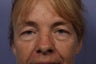 Eyelid Surgery