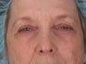Eyelid Surgery
