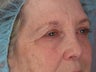 Eyelid Surgery
