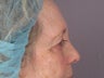 Eyelid Surgery