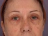 Eyelid Surgery