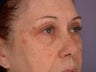 Eyelid Surgery