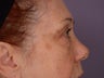 Eyelid Surgery