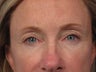 Eyelid Surgery