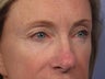 Eyelid Surgery