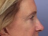 Eyelid Surgery