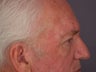 Eyelid Surgery