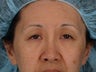 Eyelid Surgery